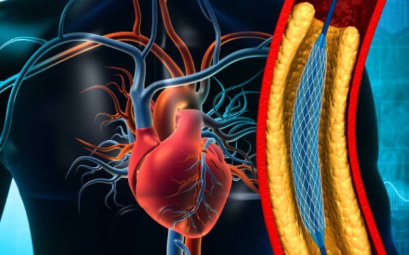 The Role Of A Cardiologist In The Treatment Of Myocardial Infarction